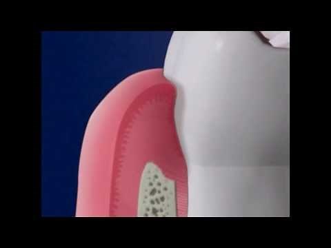 Arestin Medication for Periodontal Disease Treatment | Lake Merritt Dental, Oakland, CA