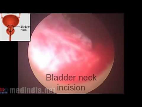 Bladder Neck Incision