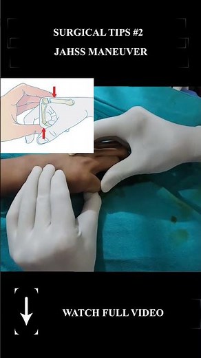Jahss Technique: Reduce a Boxer’s Fracture | Surgical Tricks #2 #doctor #anatomy #hospital #ortho