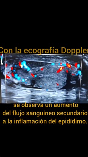 Epididimitis aguda. 🇨🇺🇨🇺 Dolor escrotal agudo. La ecografía es la modalidad de imagen de elección para evaluar a pacientes con síntomas escrotales. Las indicaciones incluyen : dolor testicular, hinchazón/masa testicular, traumatismo. #epididimitis #draliudmila #dolorescrotalagudo #ultrasonidotesticular #masatesticular | Ultrasonido