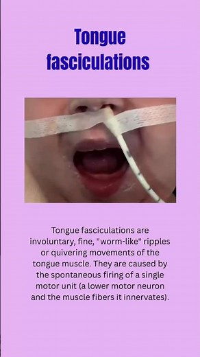 Have you seen this? Tongue Twitching Explained 👅 #medical #medicine #clinical