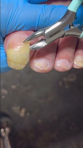 The toenails are both yellow and transparent; the trimming process is amazing! #satisfying #nails