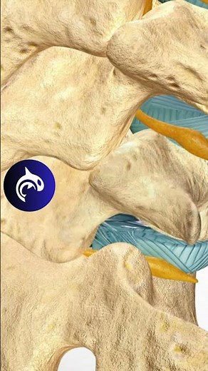 Lumbar Microdiscectomy of the Spine - See How It Works - 3D Animation #4k #backpain #chronicpain