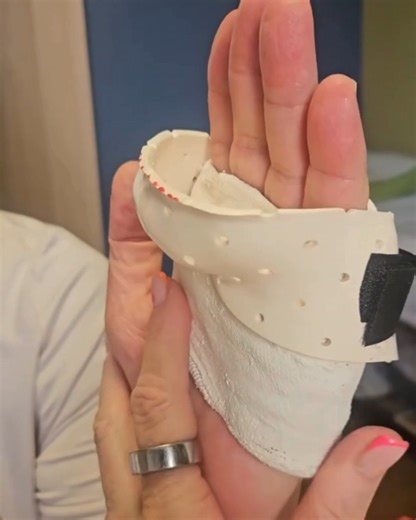 Casting Motion To Mobilize Stiffness (CMMS) on Instagram: "In the video below, the patient is wearing a removable “cast-cuff”, an exercise cast that holds the MCP joints in maximum available extension while allowing IP flexion. A thermoplastic component was placed over the exercise cast to provide a “hood fisting” target. This active exercise and positioning provide an active lengthening force to both the interossei and lumbricals. It should be noted that because this exercise cast is removable 