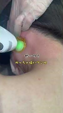 うなじ医療脱毛の痛みはどのくらい？痛みが少ない#ジェントルマックスプロプラス と技術。 #レナトゥスクリニック