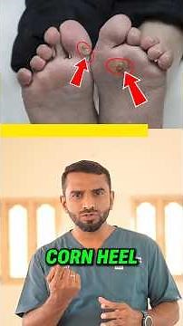 Foot corns ( Calluses): how to fix pain full corns without cutting | Energy clinic | Dr.SRK |