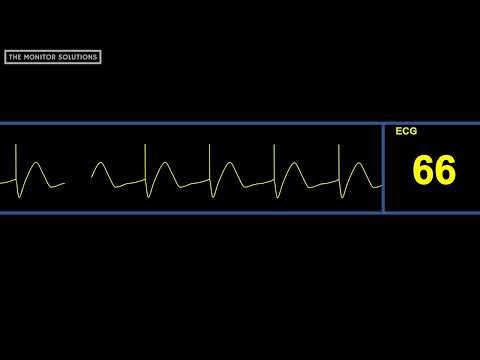 Pacing with Capture Waveform - Simulated Patient Waveform