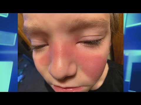 Erysipelas: What Is It and How to Treat It