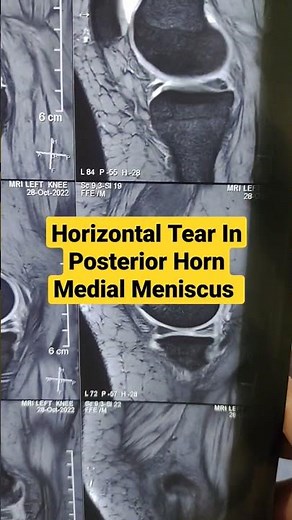 Horizontal Tear In Posterior Horn Medial Meniscus ...Dr Sai Chandra MBBS DNB Ortho...