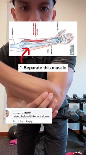 32K views · 715 reactions | Tennis elbow pain relief  FOLLOW FOR MORE REMEDY TIPS! #tenniselbow #elbowpain #tennis #tennisplayer #fypシ゚ #fyp #reelsvideo #trendingreels #physicaltherapy #physiotherapy | Physical Therapy Session | Facebook