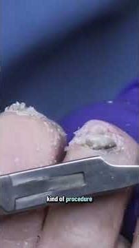 Revolutionary Vascular Procedures Healing from Within