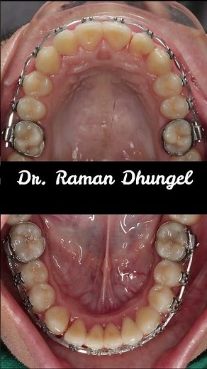 Class II division 2 Malocclusion- Fixed Orthodontic treatment