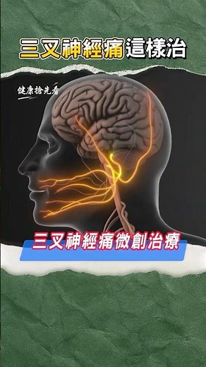 三叉神經痛不用忍！高頻熱凝療法＋照護一次看