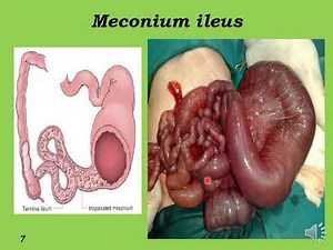 Dr. Ali Egab - pediatric surgery lecture 1 part 2 (malrotation, meconium ileus)