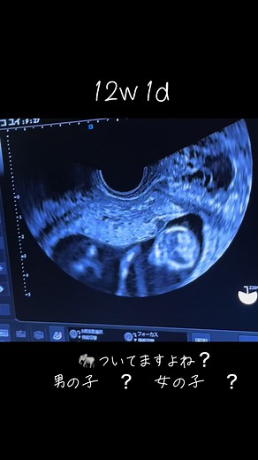 12週目の妊娠エコー映像と性別予測