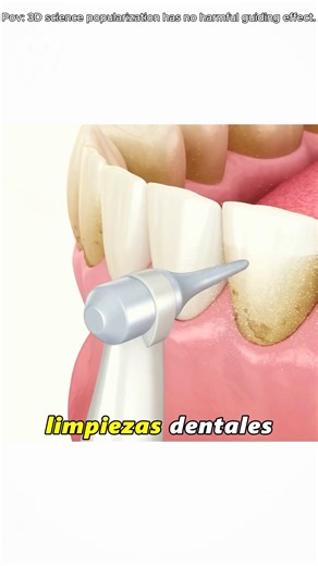 "How Dental Tooth Polishing & Plaque Removal Procedure Is Done (3D Animation) #scaling "