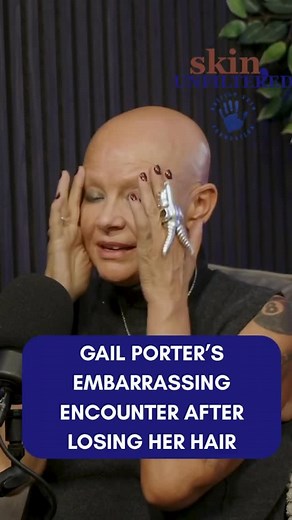 British Skin Foundation on Instagram: "Gail Porter opens up on alopecia, life under the spotlight, and finally embracing who she is – with guidance from Dr Adil Sheraz 👏 Tune into episode 4 of Skin, Unfiltered now on Spotify, Apple Podcasts & YouTube! #BritishSkinFoundation #SkinUnfiltered #SkinConditions #NewPodcast #ListenNow #EndTheStigma #Alopecia"