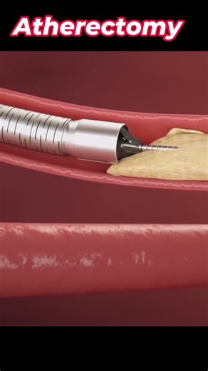 How Atherectomy Removes Artery Plaque #medicalshorts #surgerybasics #medicalprocedures