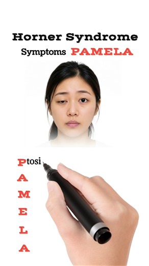 Horner's Syndrome Features