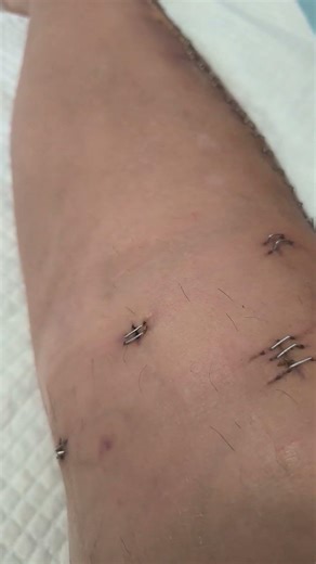 surgical staple stitches removal at home