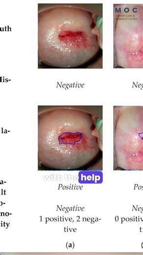 Cervical Cancer: The Power of Screening