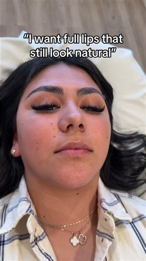 Lip Filler Results 👄