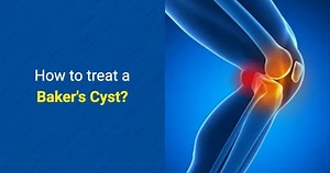 How to treat a Baker's Cyst? - OSMO Patch US