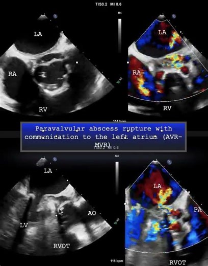 Paravalvular abscess rupture with communication to the left atrium( AVR- MVR)
