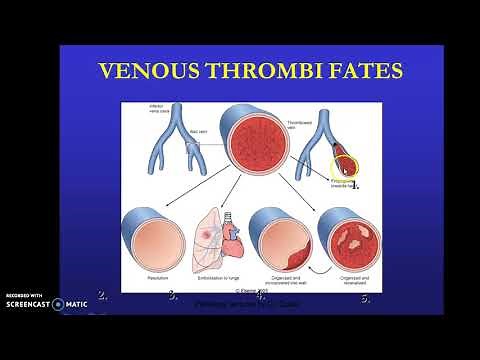 What is Thrombosis ? What is the fate of a thrombus?