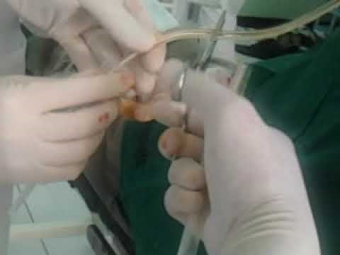 Pemasangan Water Seal Drainage (WSD)