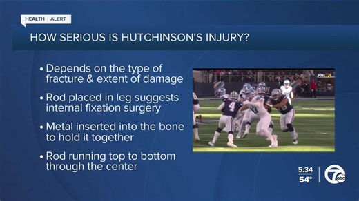 Dr. Nandi explains tibia, fibula fractures, & Aidan's possible recovery timeline