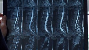 Drugs 'Cure' Back Pain In 100 Days