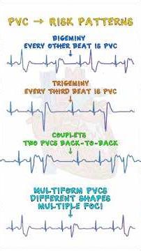 PVC - Premature Ventricular Contractions #pvc #ecg #ekg #nclex #anatomy #heartdisease #medicine