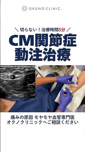 No incision required! Treatment time is 5 minutes. Intra-arterial treatment for CM joint disorders.
