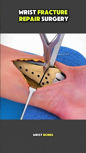 Wrist (Distal Radius) Fracture Repair Surgery | ORIF Procedure Explained #orthopedicsurgery