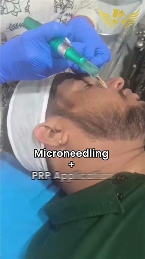 Microneedling+prp face