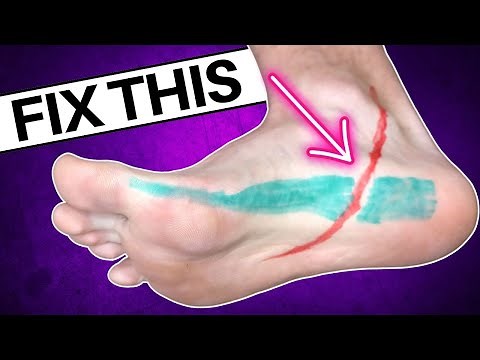 Your Plantar Fasciitis Won’t Go Away Until You Do This!