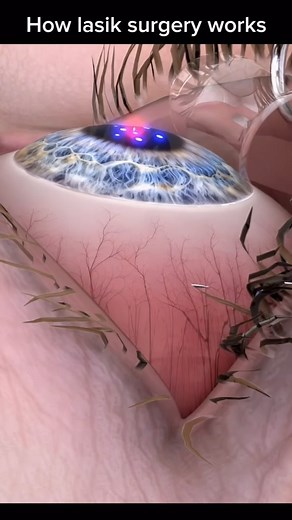 @1b1ra on Instagram: "LASIK (Laser-Assisted In Situ Keratomileusis) eye surgery is a popular procedure aimed at correcting various vision problems, such as myopia (nearsightedness), hyperopia (farsightedness), and astigmatism. The surgery utilizes advanced laser technology to reshape the cornea, the transparent front part of the eye, allowing light to enter more accurately and focus on the retina. The procedure begins with an initial evaluation by an ophthalmologist, who assesses whether the pat