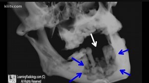 Death of bone a warning and risk for some with osteoperoisis