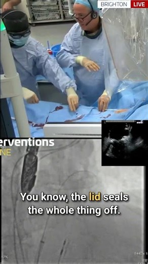 Live Case: LAAO Device Selection | Amplatzer