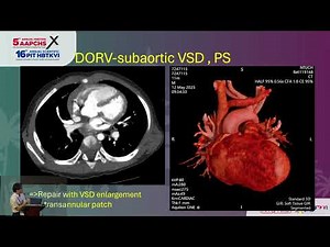DORV-PS : Biventricular Repair Strategies - Shu Chien Huang