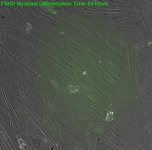 Facioscapulohumeral muscular dystrophy - Alchetron, the free social encyclopedia