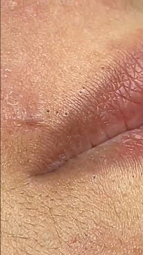 Full row of pimples under lip #blackheads #acne #acnetreatment #shortvideo