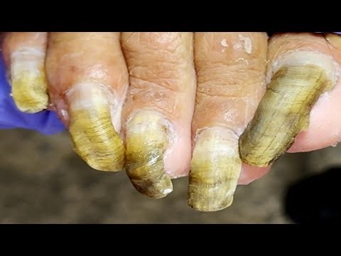 Extremely Long Toenails, Easily Trimmed One By One【Pedicure King】