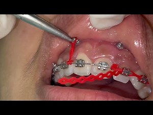 Gummy smile with orthodontic mini screws, incisors intrusion with TADs with power chain placement