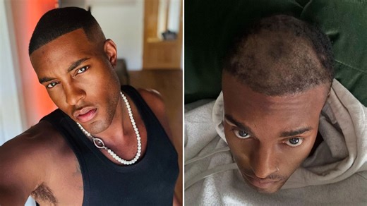 I’m Tinder’s most swiped-right man but my dates had no idea I was secretly bald