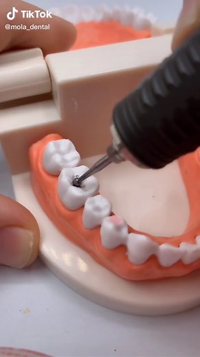 Filling a Cavity: A Step-by-Step Guide