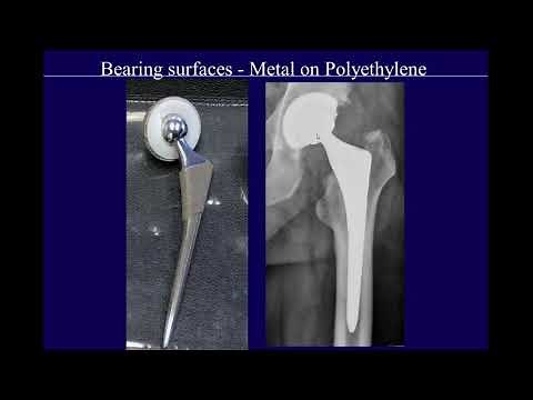 Radiographic analysis of prosthetic hip