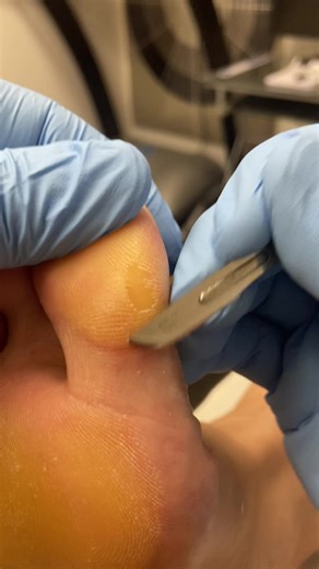 Thick Big Toe Callus Removal by a Podiatrist