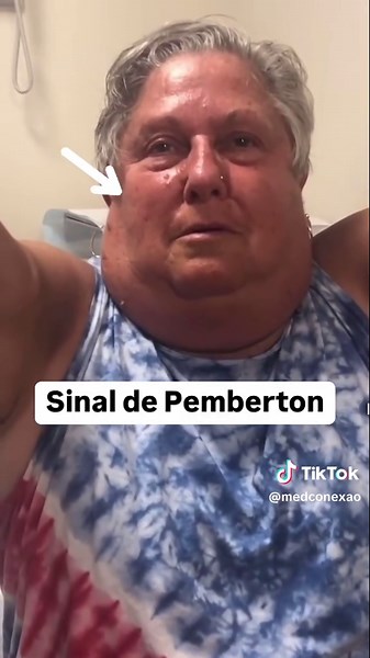 Sinal de Pemberton: Avaliação Clínica e Relevância